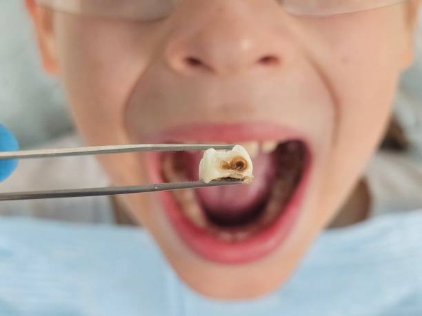 Best Emergency Dental Extractions in Sebring, FL